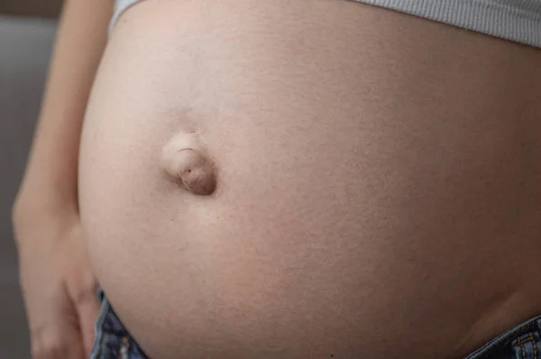 Hernia Umbilikal pada wanita hamil. Penutup Stok Gambar