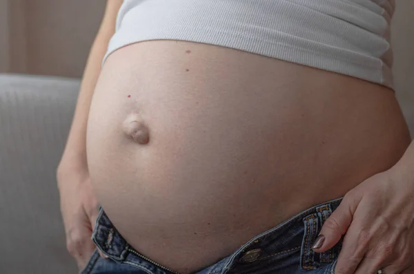 Umbilical hernia in a pregnant woman. Closeup — Stock Image Umbilical hernia in a pregnant woman. Closeup Royalty Free Stock Photos