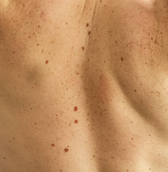 Detalle de cerca de la piel desnuda en un hombre de nuevo con lunares dispersos y pecas. Comprobación de lunares benignos — Foto de Stock