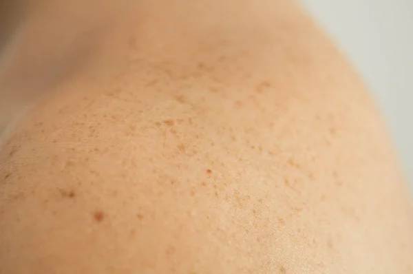 Detalle de cerca de la piel desnuda en un hombre de nuevo con lunares dispersos y pecas. Comprobación de lunares benignos —  Fotos de Stock