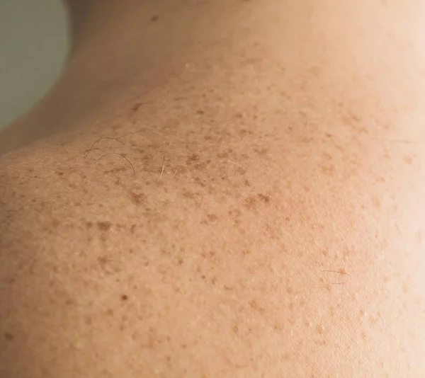 Крупные детали обнаженной кожи на спине человека с рассеянными родинками и веснушками. Проверка доброкачественных родинок — стоковое фото