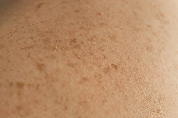 Detalle de cerca de la piel desnuda en un hombre de nuevo con lunares dispersos y pecas. Comprobación de lunares benignos — Foto de Stock