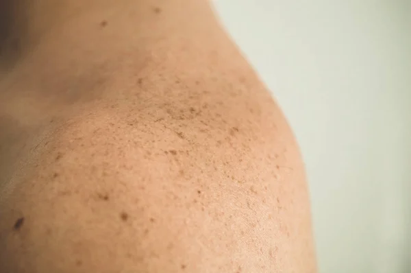 Dettaglio ravvicinato della pelle nuda su un uomo indietro con talpe sparse e lentiggini. Controllo delle talpe benigne — Foto Stock