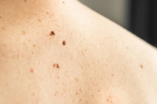 Détail rapproché de la peau nue sur un dos d'homme avec des grains de beauté éparpillés et des taches de rousseur. Vérification des taupes bénignes — Photo