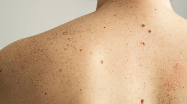 Détail rapproché de la peau nue sur un dos d'homme avec des grains de beauté éparpillés et des taches de rousseur. Vérification des taupes bénignes — Photo