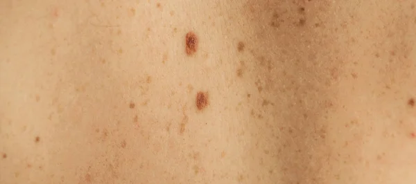 Close up detail of the bare skin on a man back with scattered moles and freckles. Checking benign moles — Stock Photo, Image