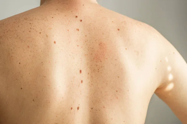 Détail rapproché de la peau nue sur un dos d'homme avec des grains de beauté éparpillés et des taches de rousseur. Vérification des taupes bénignes — Photo