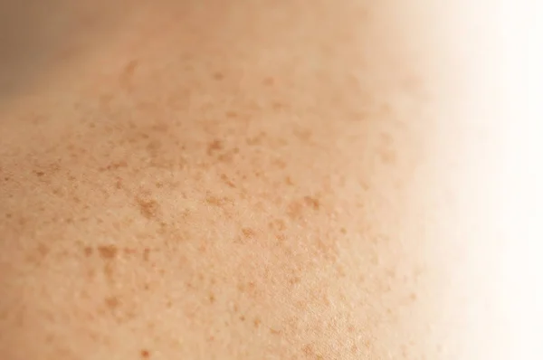 Nahaufnahme der nackten Haut auf dem Rücken eines Mannes mit verstreuten Muttermalen und Sommersprossen. Kontrolle gutartiger Maulwürfe — Stockfoto