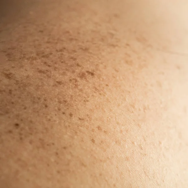 Крупные детали обнаженной кожи на спине человека с рассеянными родинками и веснушками. Проверка доброкачественных родинок — стоковое фото