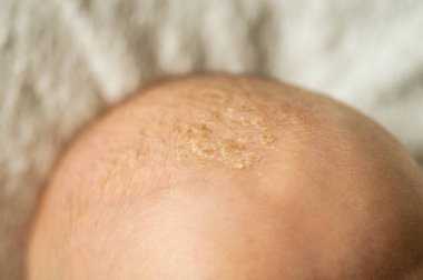 Kafasında bebek kabuğu var. Bebek başında seboreik kabuk, yakın çekim, Seboreik dermatit, inflamatuar. 
