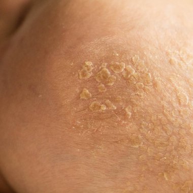 Kafasında bebek kabuğu var. Bebek başında seboreik kabuk, yakın çekim, Seboreik dermatit, inflamatuar. 