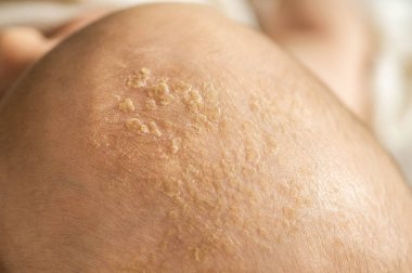 Kafasında bebek kabuğu var. Bebek başında seboreik kabuk, yakın çekim, Seboreik dermatit, inflamatuar. 