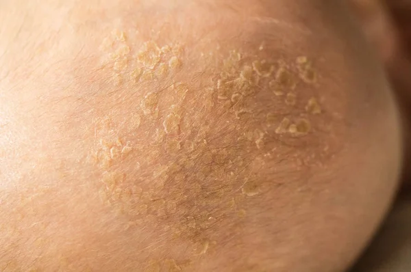 Una corteza de bebé en la cabeza. Corteza seborreica en la cabeza del bebé, primer plano, dermatitis seborreica, inflamación . — Foto de Stock