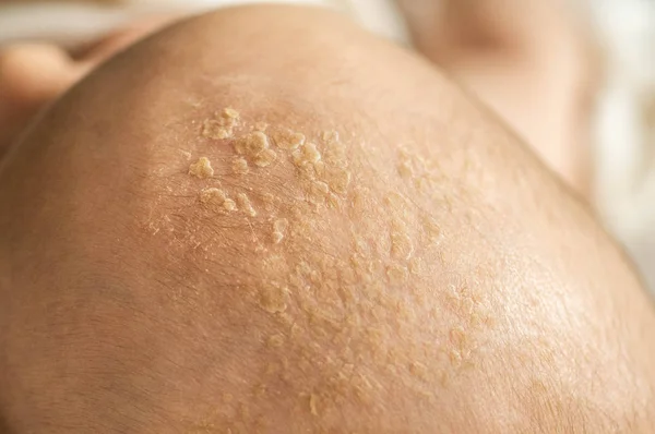 Una corteza de bebé en la cabeza. Corteza seborreica en la cabeza del bebé, primer plano, dermatitis seborreica, inflamación . —  Fotos de Stock