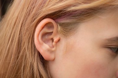 Genç bir kızda dış kulağın iyi huylu neoplazmaları. Doğuştan kulak uzantısı..