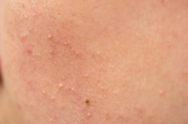 Sorunlu cilt. Sivilce ve kırmızı sivilceler genç bir kızın yüzünde. Genç kızlar için yüz bakımı. 