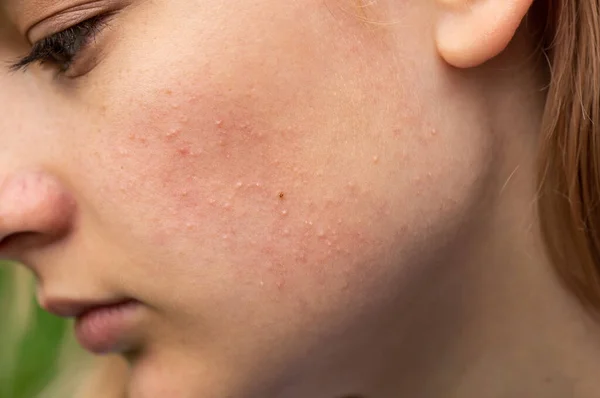 Piel problemática. Acné y granos rojos supurantes en la cara de una niña. Faciales para chicas adolescentes . —  Fotos de Stock