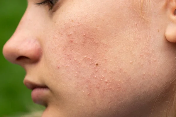 Pele problemática. Acne e borbulhas vermelhas no rosto de uma jovem. Cum Facial para meninas adolescentes . — Fotografia de Stock