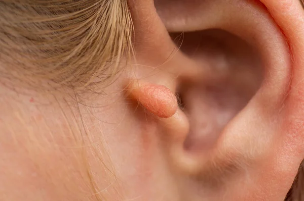 Benign neoplasms of the outer ear in a teenage girl. Congenital ear appendage.