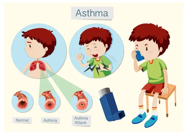 Anatomia Umana Salute Illustrazione Dell Asma — Vettoriale Stock