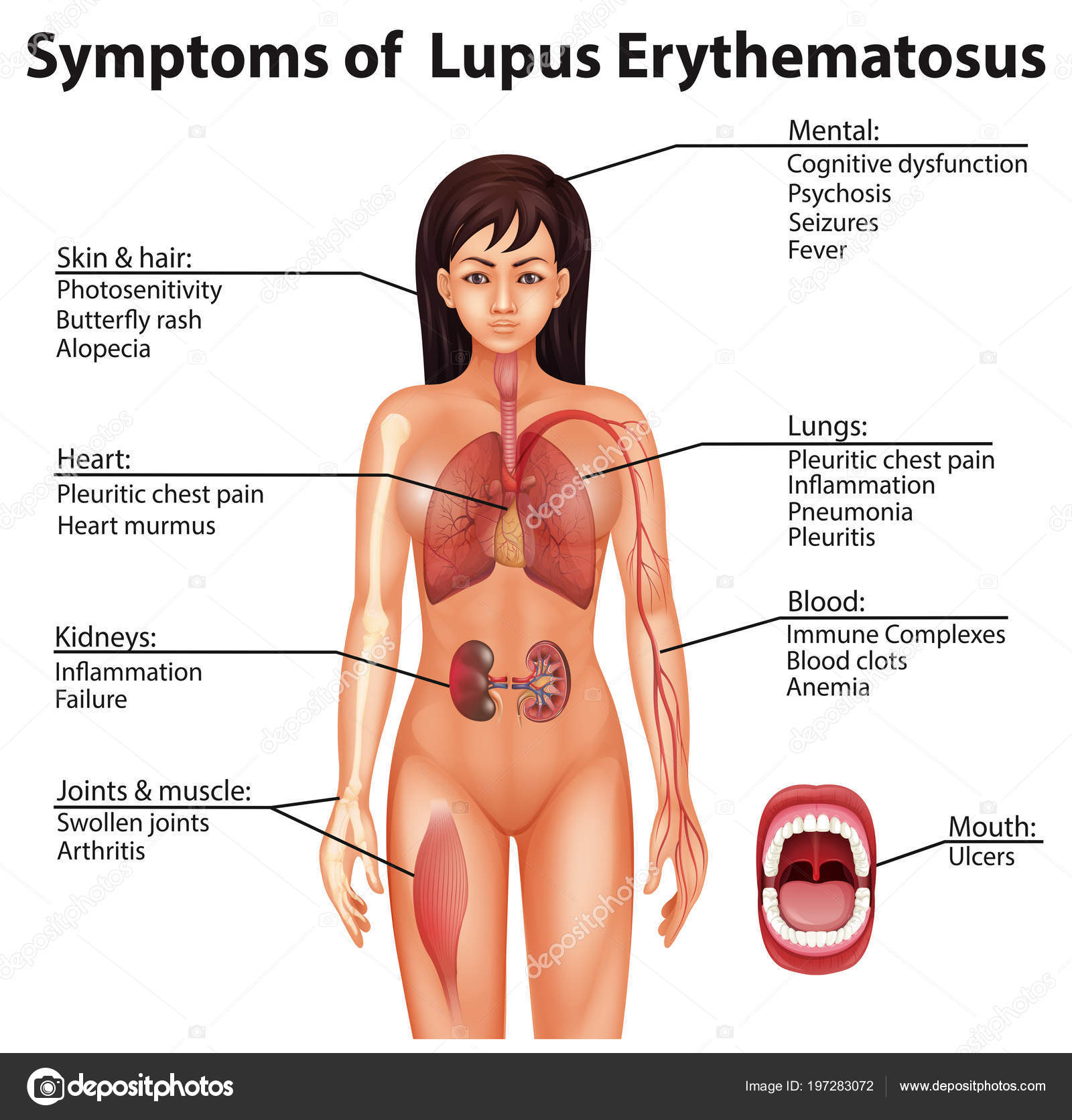Human Anatomy Symptoms Lupus Erythematosus Illustration Stock Vector