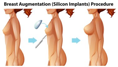 Bir vektör, kadın meme implantları illüstrasyon