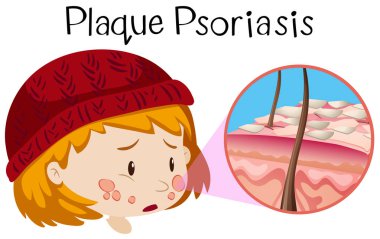 Anatomi plak psoriazis illüstrasyon insan