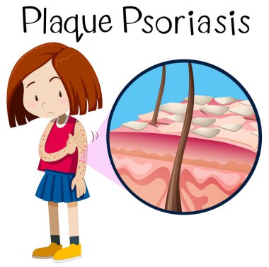 Bir vektör kız plak psoriazis illüstrasyon