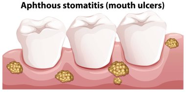 Human Anatomy of Aphthous Stomatitis illustration clipart