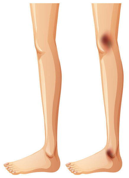 Human Legs and Bruise on White Background illustration