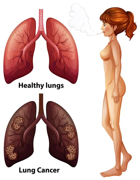 Lidské Anatomie Plic Kuřáka Ilustrace — Stockový vektor