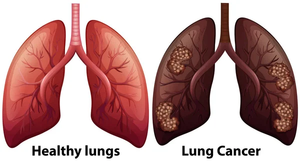 Człowiek Ilustracja Anatomii Chorobę Płuc — Wektor stockowy