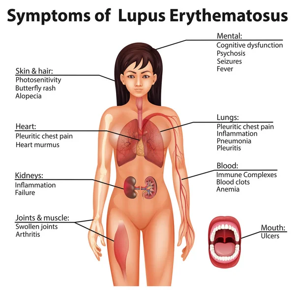 Menselijke Anatomie Symptomen Van Lupus Erythematosus Illustratie — Stockvector