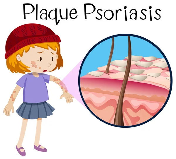 Menselijke Anatomie Van Plaque Psoriasis Illustratie — Stockvector