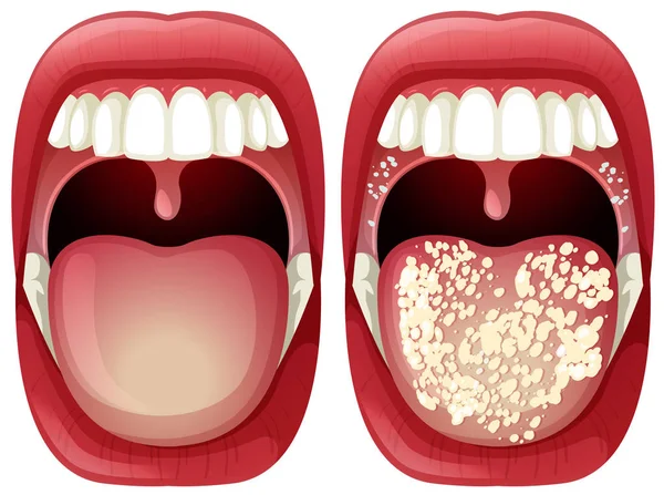 Vettore Sano Virus Bocca Illustrazione — Vettoriale Stock