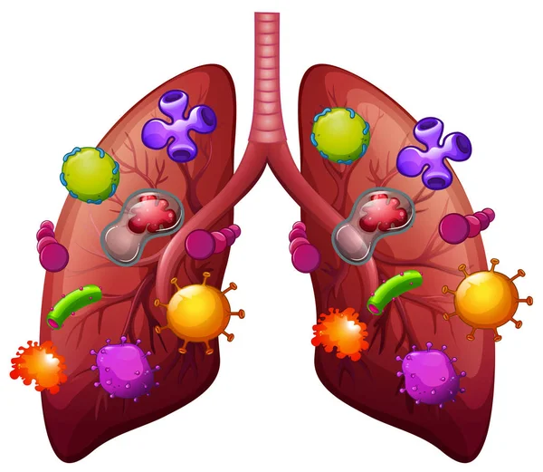Płuc Pokryte Ilustracja Bakterii — Wektor stockowy