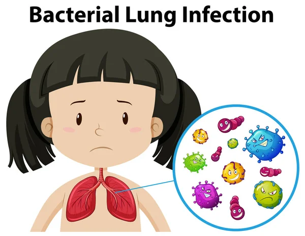 Vetor Infecção Pulmonar Bacteriana Ilustração — Vetor de Stock