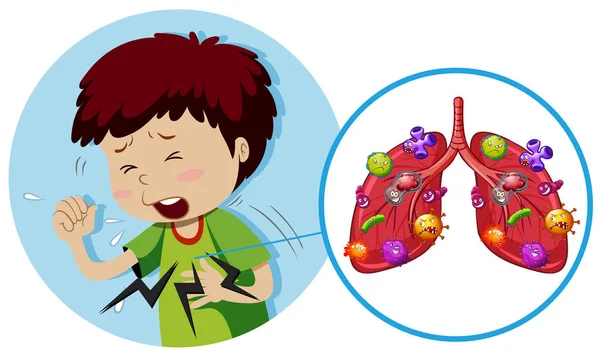 Young Boy Bacteria Lungs Illustration — Stock Vector