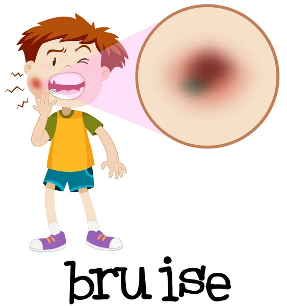 Magnified Boy Bruise Illustration — Stock Vector