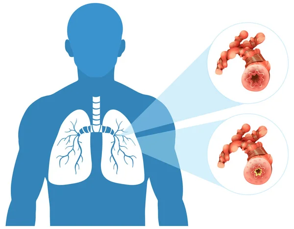 白背景イラストを人間の肺 — ストックベクタ