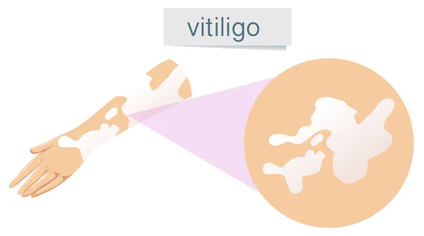 Vector Vitiligo Piel Ilustración — Archivo Imágenes Vectoriales