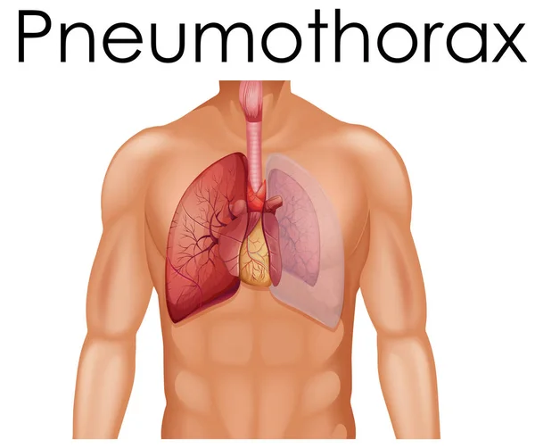 Uma Anatomia Humana Ilustração Pneumotórax — Vetor de Stock