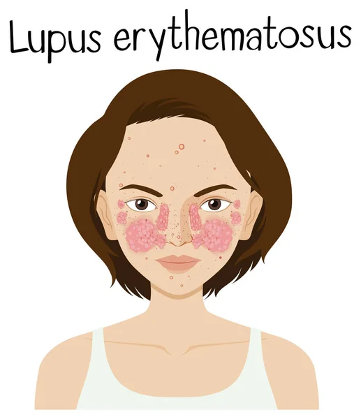 Een Illustratie Vector Van Lupus Erythematosus — Stockvector