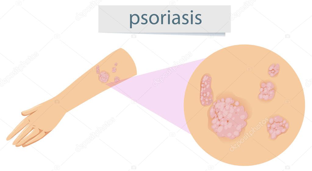 Magnified psoriasis on arm illustration