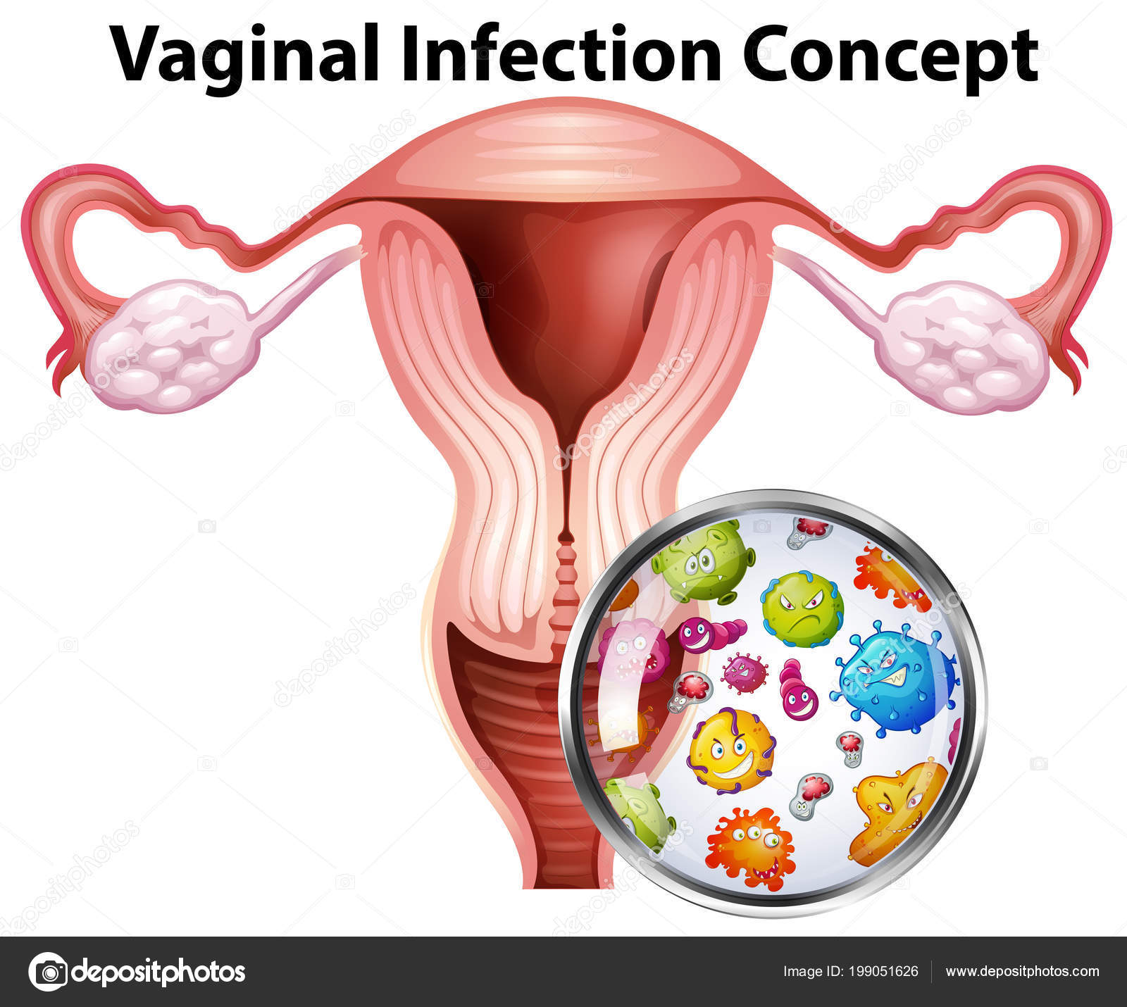 vaginal-infection-bacteria-concept-illustration-stock-vector-by