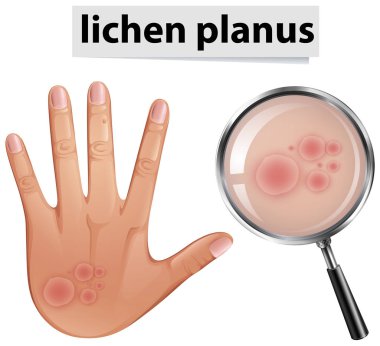 Bir insan cilt sorun liken Planus illüstrasyon