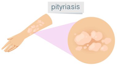 Pityriasis illüstrasyon insan derisi üzerinde