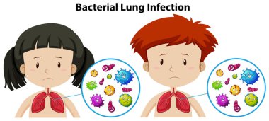 A Set of Bacterial Lung Infection illustration clipart
