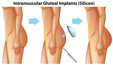Beyaz arka plan illüstrasyon üzerinde Gluteal kas içi implantları