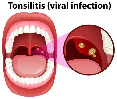 A Human Mouth Tonsillitis Infection illustration clipart